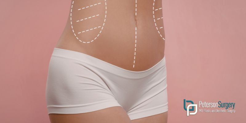 SURGICAL VS NON-SURGICAL BODY CONTOURING: WHICH OPTION IS RIGHT FOR YOU? - KELOWNA BODY CONTOURING